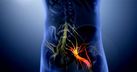 Sciatica Vs Herniated Disc - Dr. Kevin Pauza, The Discseel® Procedure inventor