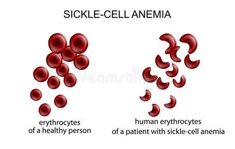 Normal Red Blood Cell and Sickle Cell Stock Vector - Illustration of ...