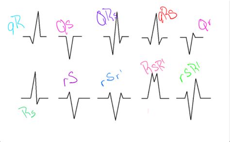 Ekg Flashcards Quizlet