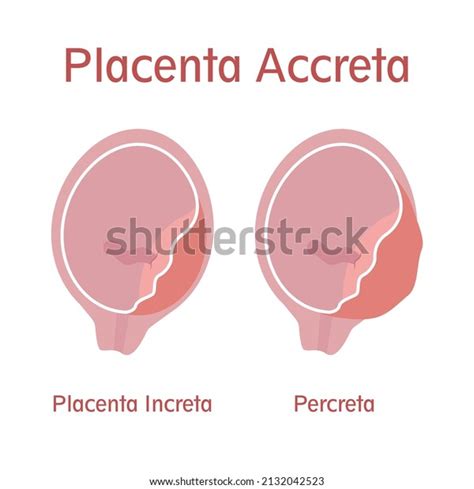 Types Of Placenta Accreta Placenta Increta And Percreta Vector Hot