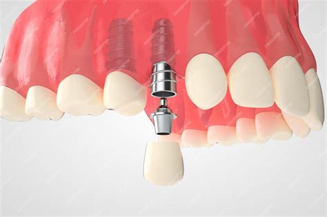 Premium Photo Tooth Human Implant Dental Implantation Concept Human Teeth Or Dentures