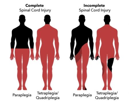 Spinal Cord Injury And Paralysis Total Community Care