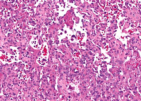 Anastomosing Haemangioma Of The Adrenal Gland A Clinicopathological