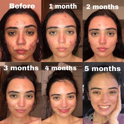 My Accutane Journey I Feel Like A New Person Raccutane