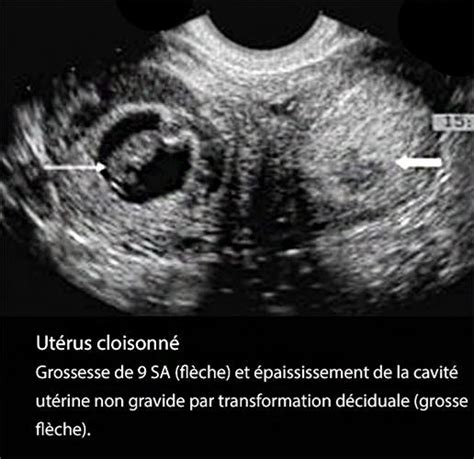 Grossesse Et Malformations Ut Rines Dr Kara Zaitri M A