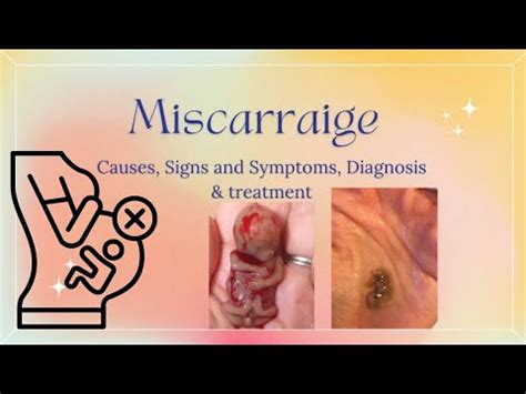 Miscarriages Causes Symptoms Diagnosis And Treatment Youtube