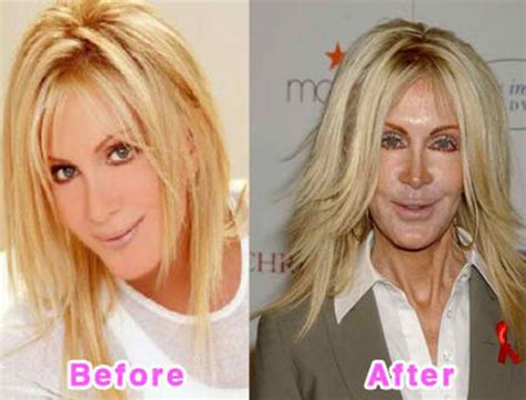 Celebrity Plastic Surgery Before And After 56 Pics