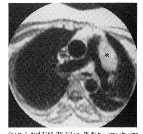 Figure From Magnetic Resonance Imaging Of Mediastinal Paraganglioma