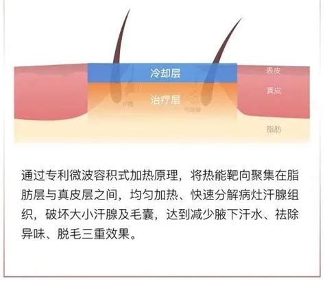 Miradry清新微波，告别腋下困扰 知乎