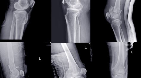 A Brief Guide To Knee Fractures Chris Bailey Orthopaedics