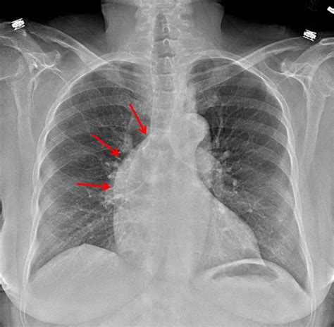 Ascending Aortic Arch Aneurysm