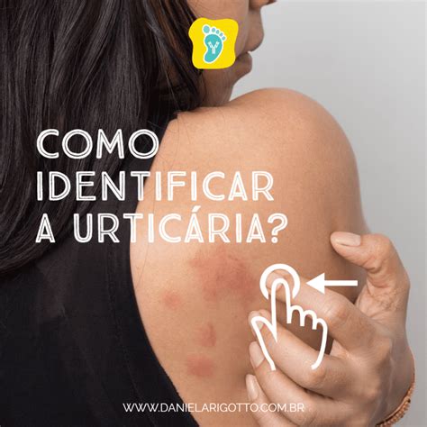 Como identificar a urticária Dra Daniela T Rigotto Bannwart