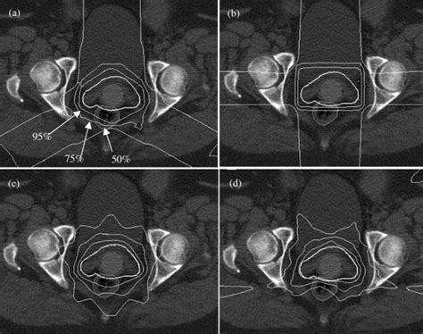 3d Conformal Versus Intensity Modulated Postoperative Radiotherapy Of Vaginal Vault A