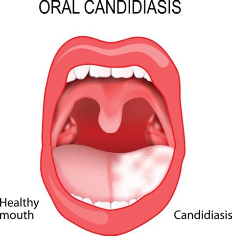 Mild Oral Thrush On Tongue