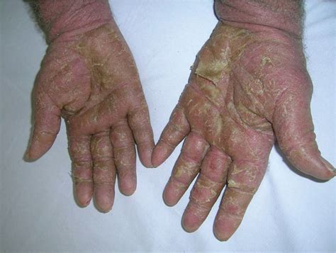 Drug Rash With Eosinophilia And Systemic Symptoms Syndrome Associated With Isoniazid