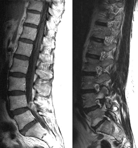 Synovial Cyst of the Lumbar Spine ~ Medical OSCES