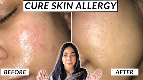 How To Cure Skin Allergy Honest Skincare Shamaim Rajpoot Youtube