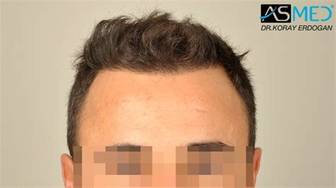 2400 Grafts Fue | Norwood 2 | Asmed Hair Transplant Results