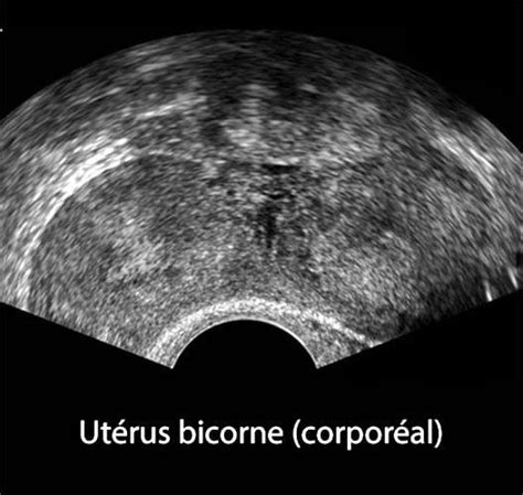 Malformations Ut Rines Chographie Dr Kara Zaitri M A