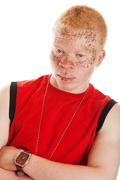 African Albino Stock Photos Pictures And Royalty Free Images Istock