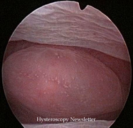 Role Of Diagnostic Hysteroscopy In Infertility Hysteroscopy Newsletter