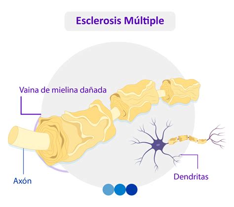 Esclerosis Múltiple Em Información Especializada Medforum