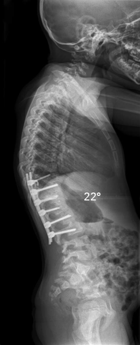 Thoracolumbar Kyphosis In Patients With Mucopolysaccharidoses Bone