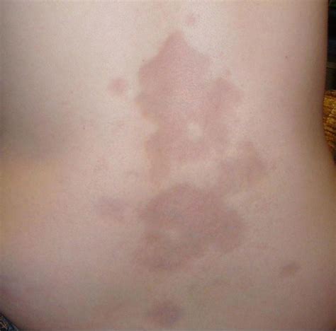 Morphea Alchetron The Free Social Encyclopedia