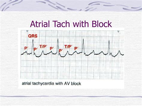 Ppt Basic Ekg Interpretation Powerpoint Presentation Free Download