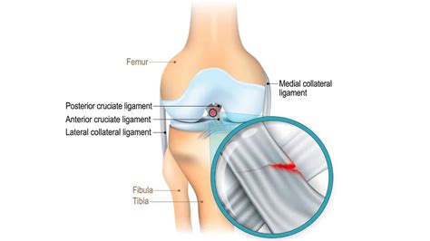 Acl Sprain Anterior Cruciate Ligament Sprains