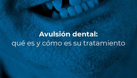 Avulsión dental: qué es y cómo es su tratamiento - CCM Dental