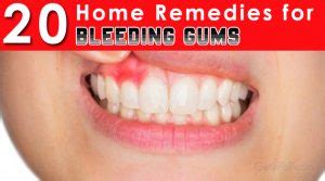 20 Home Remedies For Bleeding Gums - Getinfopedia.com