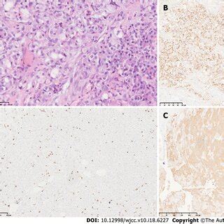 Histology And Immunohistochemistry Of The Tumor A Hematoxylin And