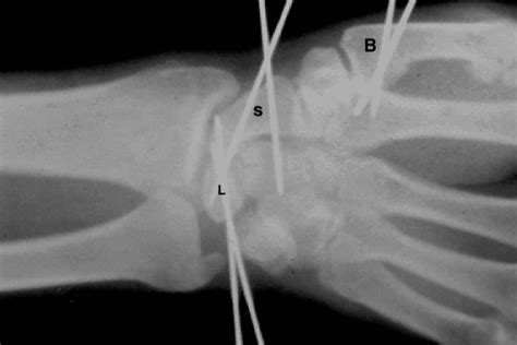 Scapholunate Ligament Injury Melbourne Hand Surgery 264