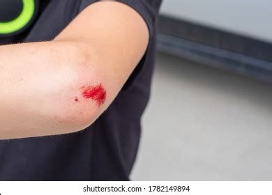 thousand elbow wound royalty  images stock  pictures