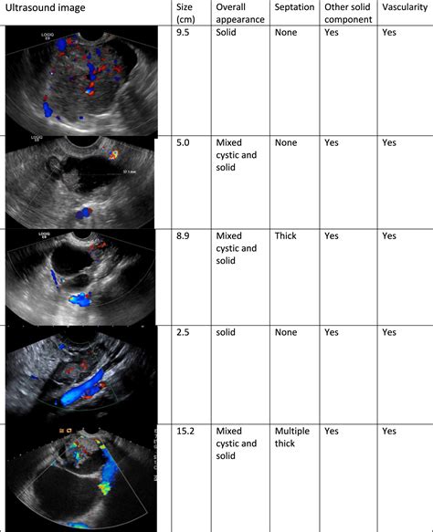 Ultrasound Characteristics Of Early Stage High Grade Serous Ovarian