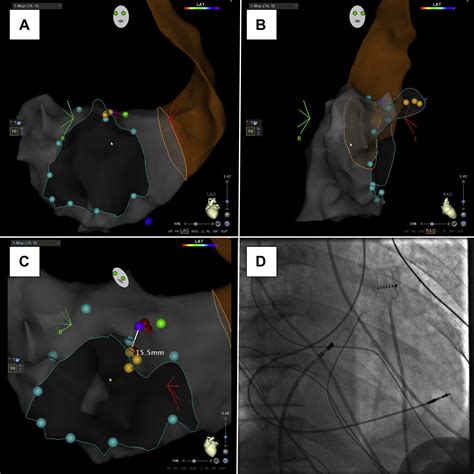 Electroanatomic Mapping In Atrioventricular Junction Ablation And