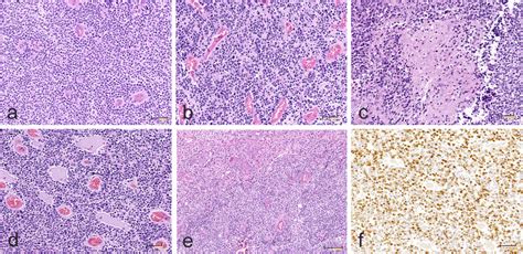 Morphology Of Cns Nb Foxr Tumors A Highly Cellular Tumor Composed Of