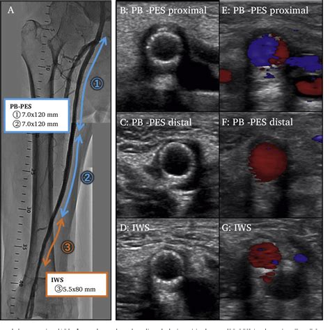 Figure From Angiographic And Intravascular Imaging Findings For