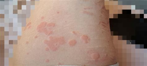 What Is This Rash On My Inner Thigh R Dermatologyquestions