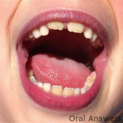 The Differences Between Baby Teeth And Permanent Teeth Oral Answers