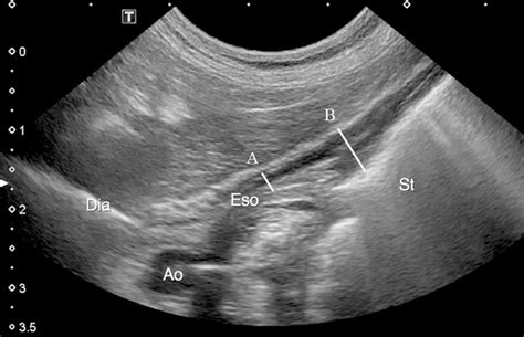 Gastroesophageal Junction Ultrasound