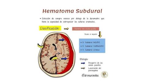 Hematoma Subdural Agudo Y Cronico 1 Pptx