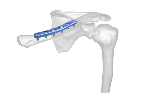 Clavicle Plating System | Acumed