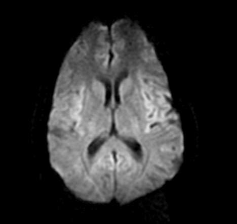 Normal Brain MRI Anatomy