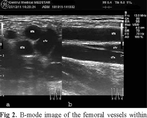 Deep Femoral Artery Ultrasound