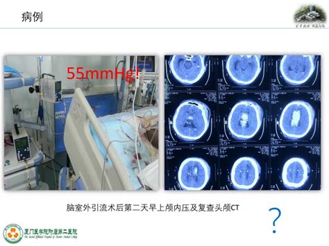 监测有道丨弥漫性轴索损伤并发脑室积血颅内压监测一例——颅脑创伤 神经重症周刊（第196期） 脑医汇 神外资讯 神介资讯