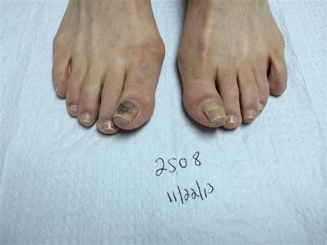 Toenail Fungus Before and After Photos - Advanced Podiatry of Manhasset ...