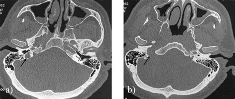 A Rare Case Of Jugular Bulb Diverticulum Presenting As Menieres