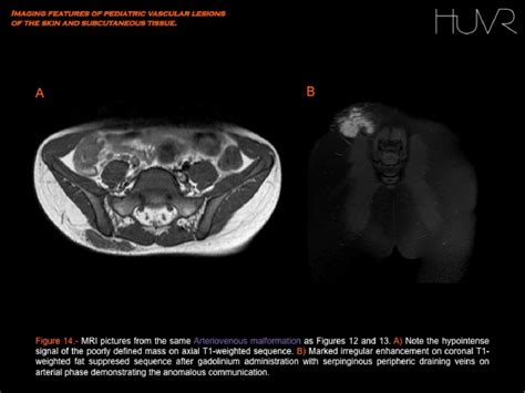 Figure 7 From Imaging Features Of Pediatric Vascular Malformations Of The Skin And Subcutaneous